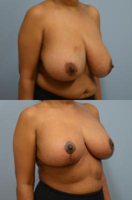 Before(top pic) After (bottom pic): Oncoplastic Breast Reduction