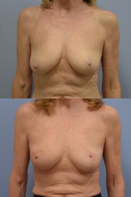 Before(top pic) After (bottom pic): Oncoplastic Breast Reduction