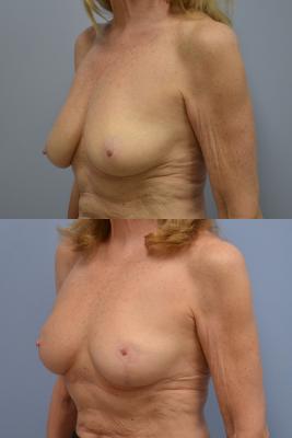 Before(top pic) After (bottom pic): Oncoplastic Breast Reduction