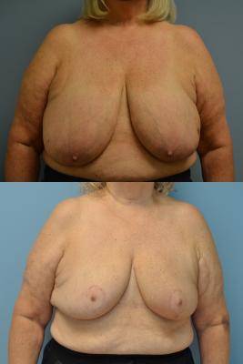 Before(top pic) After (bottom pic): Oncoplastic Breast Reduction