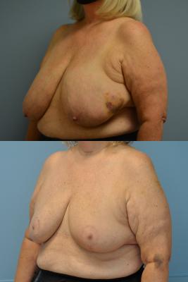 Before(top pic) After (bottom pic): Oncoplastic Breast Reduction