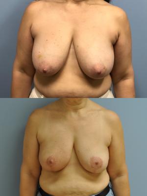 Before(top pic) After (bottom pic): Oncoplastic Breast Reduction