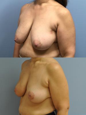 Before(top pic) After (bottom pic): Oncoplastic Breast Reduction