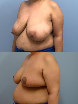 Before(top pic) After (bottom pic): Oncoplastic Breast Reduction