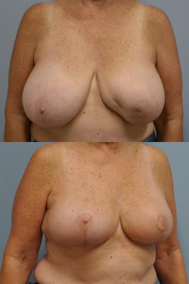 Before(top pic) After (bottom pic): Oncoplastic Breast Reduction