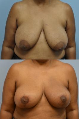 Before(top pic) After (bottom pic): Oncoplastic Breast Reduction