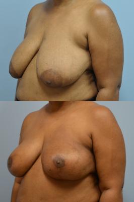 Before(top pic) After (bottom pic): Oncoplastic Breast Reduction