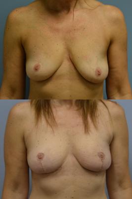 Before(top pic) After (bottom pic): Oncoplastic Breast Reduction