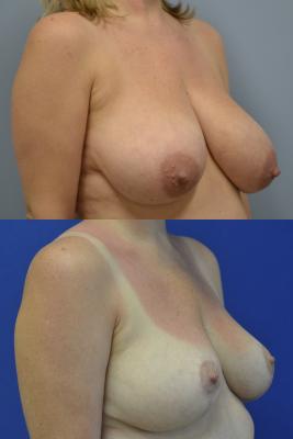 Before(top pic) After (bottom pic): Breast Reconstruction