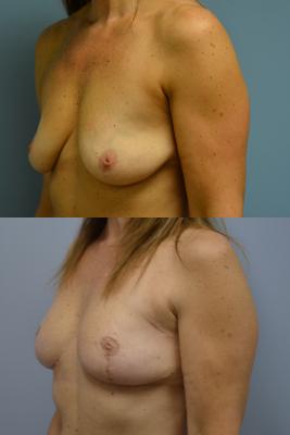 Before(top pic) After (bottom pic): Oncoplastic Breast Reduction