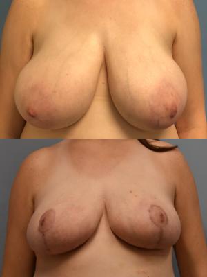 Before(top pic) After (bottom pic): Breast Reduction