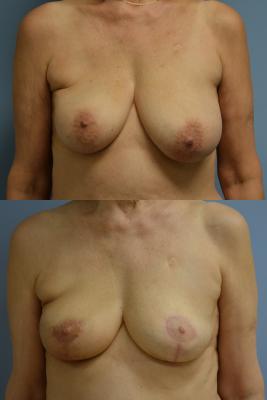 Before(top pic) After (bottom pic): Oncoplastic Breast Reduction