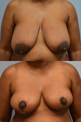 Before(top pic) After (bottom pic): Breast Reduction