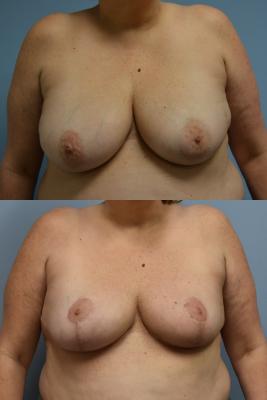 Before(top pic) After (bottom pic): Oncoplastic Breast Reduction