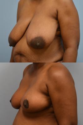 Before(top pic) After (bottom pic): Breast Reconstruction