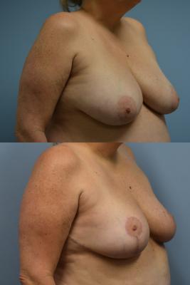 Before(top pic) After (bottom pic): Oncoplastic Breast Reduction