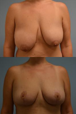 Before(top pic) After (bottom pic): Breast Reduction