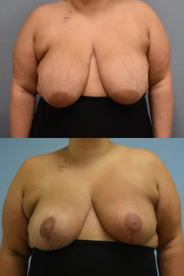 Before(top pic) After (bottom pic): Oncoplastic Breast Reduction