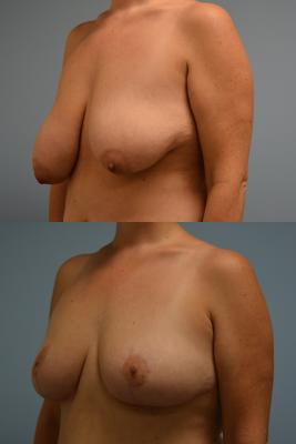 Before(top pic) After (bottom pic): Breast Reduction