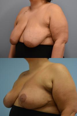 Before(top pic) After (bottom pic): Oncoplastic Breast Reduction