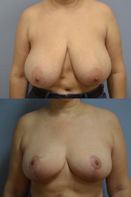 Before(top pic) After (bottom pic): Breast Reduction