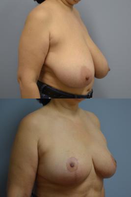 Before(top pic) After (bottom pic): Breast Reduction