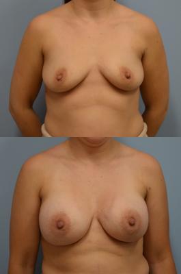 Before(top pic) After (bottom pic): breast augmentation