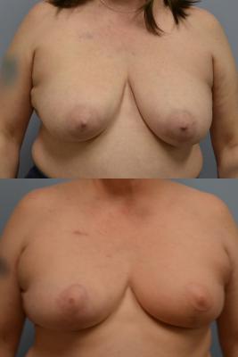 Before(top pic) After (bottom pic): Oncoplastic Breast Reduction