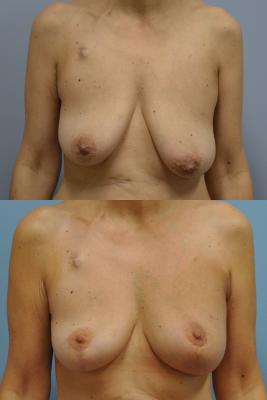 Before(top pic) After (bottom pic): Oncoplastic Breast Reduction