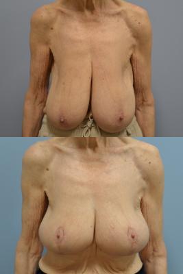 Before(top pic) After (bottom pic): Breast Reduction