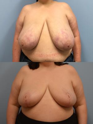 Before(top pic) After (bottom pic): Breast Reduction