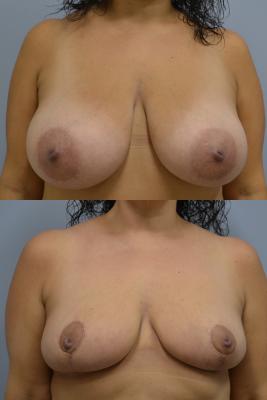 Before(top pic) After (bottom pic): Breast Reduction