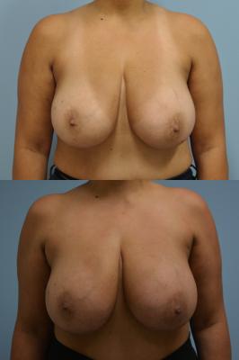 Before(top pic) After (bottom pic): Breast Reconstruction Fat Grafting