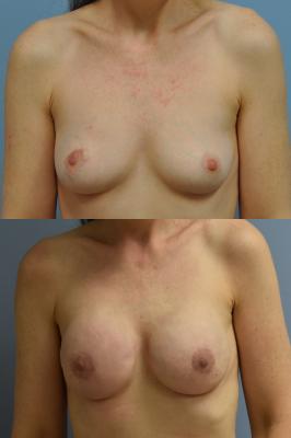 Before(top pic) After (bottom pic): Breast Reconstruction