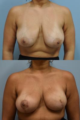 L expander exchange to implant and R breast reduction for symmetry