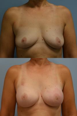 Before(top pic) After (bottom pic): Breast Reconstruction