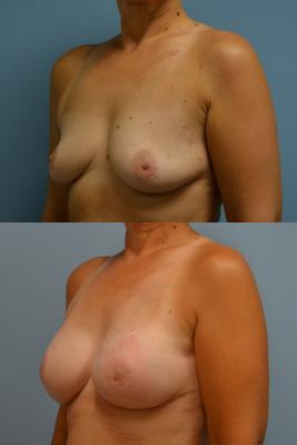 Before(top pic) After (bottom pic): Breast Reconstruction