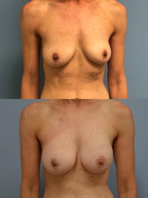 Before(top pic) After (bottom pic): Breast Reconstruction