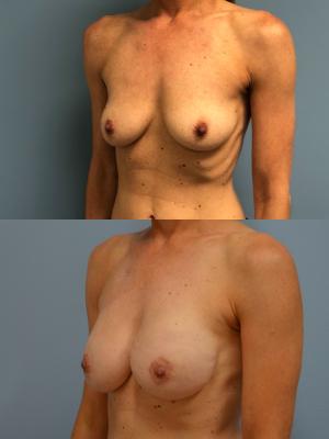 Before(top pic) After (bottom pic): Breast Reconstruction