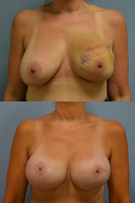 Before(top pic) After (bottom pic): Breast Reconstruction