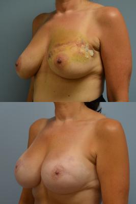 Before(top pic) After (bottom pic): Breast Reconstruction