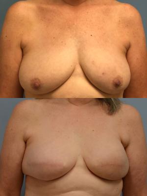 Before(top pic) After (bottom pic): Breast Reconstruction