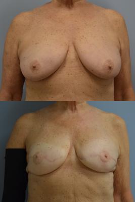 Before(top pic) After (bottom pic): Breast Reconstruction