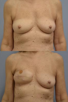 Right expander exchange to permanent implant, revision right reconstructed breast, and Left mastopexy/augmentation for symmetry