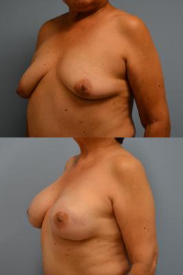 Before(top pic) After (bottom pic): Breast Reconstruction