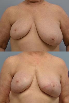 Before(top pic) After (bottom pic): Breast Reconstruction