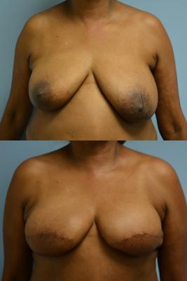 Before(top pic) After (bottom pic): Breast Reconstruction