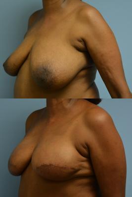 Before(top pic) After (bottom pic): Breast Reconstruction