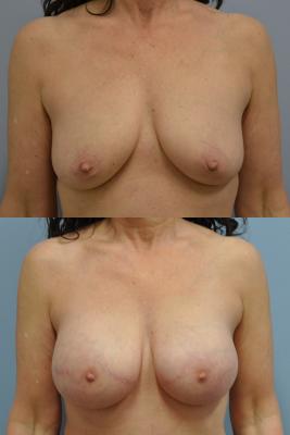 Before(top pic) After (bottom pic): Breast Reconstruction