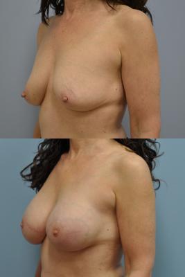 Before(top pic) After (bottom pic): Breast Reconstruction